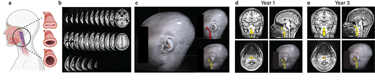 Measuring the airway from routine brain MRI.