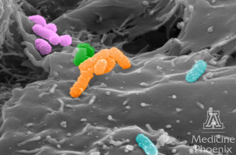 Pseudocolored scanning electron microscopy image of human 3-D cervical epithelial cells infected with a polymicrobial cocktail of four key bacterial species associated with bacterial vaginosis. 