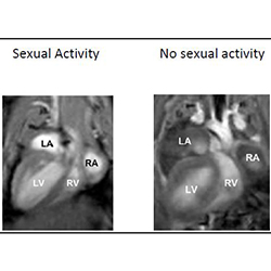 Study Suggests Sexual Activity Can be Beneficial in Heart Failure