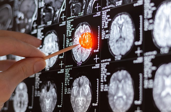 A medical scan of a brain tumor
