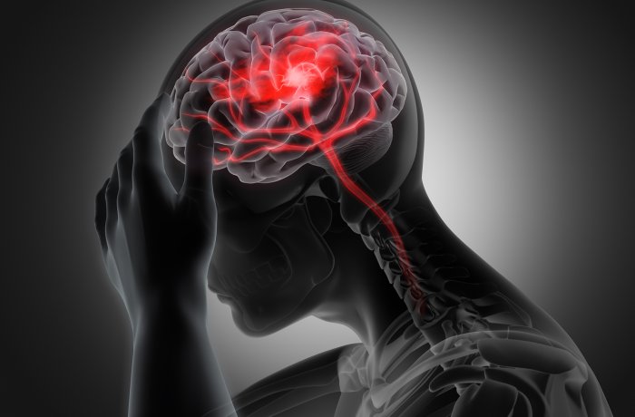 A graphic of someone experiencing an intense headache